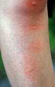 Image result for Allergic Reaction to Bug Bite