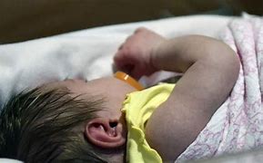 Image result for Babies with Syphilis