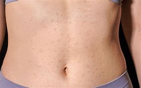 Image result for Covid 19 Rash On Skin Symptoms