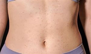 Image result for All Body Rashes