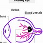 Image result for Retina Diabetic Retinopathy