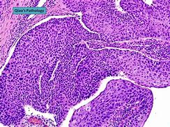Image result for Laryngeal Squamous Cell Papilloma