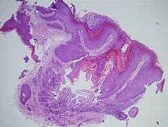 Image result for Warty Dyskeratoma