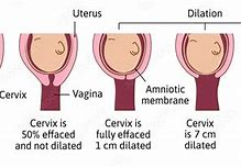 Image result for 2 Cm Dilated Cervix