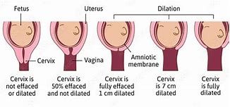 Image result for Cervix Dilation Diagram