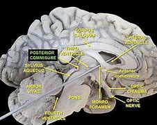 Image result for Posterior Commissure Connects