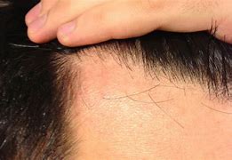 Image result for Vellus Hair Minoxidil