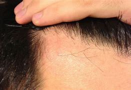 Image result for Vellus Alopecia