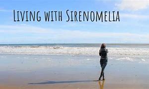 Image result for Sirenomelia Survivors 27 Years Old