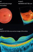 Image result for Retinal Tear Oct
