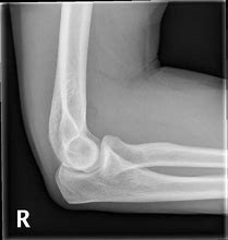 Image result for X-ray of Elbow Joint