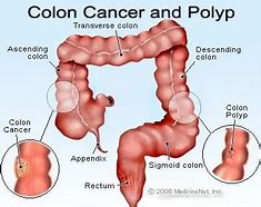 Image result for Images of Cancerous Colon Polyps