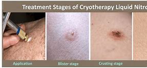 Image result for Cryotherapy Skin Lesion