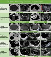 Image result for Ovarian Daughter Cyst Ultrasound