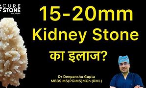 Image result for 15Mm Kidney Stone
