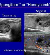 Image result for Spongiform Thyroid