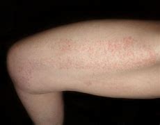 Image result for Large Red Spots On Skin