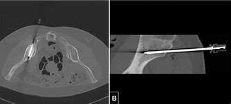 Image result for Microwave Ablation Bone Tumor