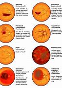 Image result for Causes of Retinal Hemorrhage