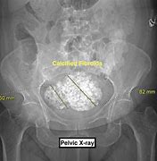 Image result for Calcified Uterine Fibroid