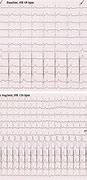 Image result for Accelerated Idioventricular Rhythm