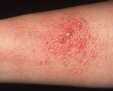 Image result for Itchy Skin Rash with Blisters