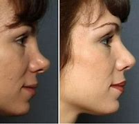 Image result for Reduce Nose Size