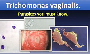 Image result for Trichomoniasis Real Life Pictures