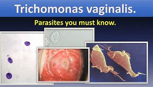 Image result for Vaginali Trichomonas Infection