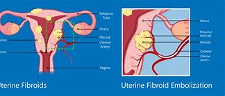 Image result for 4 Cm Uterine Fibroid