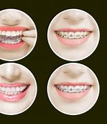 Image result for Braces On Fake Teeth