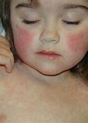 Image result for Early Symptoms of Fifth Disease