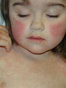 Image result for Fifth Disease in Adults Symptoms