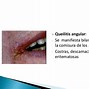 Image result for axtinomicosis