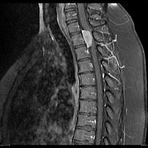 Image result for Meningioma Cervical Spine Tumor