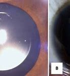Image result for Slit Lamp Toric Contact Lens