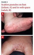 Image result for Scabies On Ankles