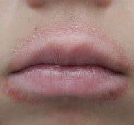 Image result for Food Allergy Rash around Mouth