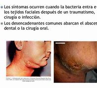 Image result for actinomicosis