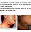 Image result for adtinomicosis
