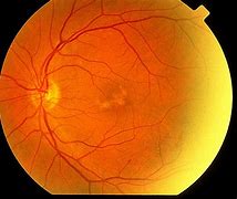 Image result for Retinal Dystrophy