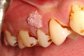Image result for Papilloma Growth