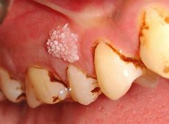 Image result for Gingival Papilloma