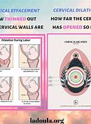 Image result for 1 Cm Dilated Cervix