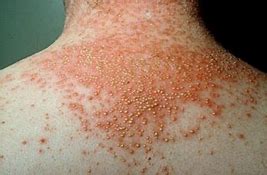 Image result for Pustular Psoriasis On Back
