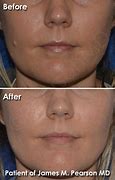 Image result for Mole Removal On Face Scarring