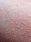 Image result for Allergy Bumps