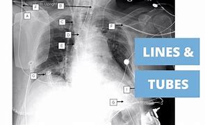 Image result for Chest Tube Patient