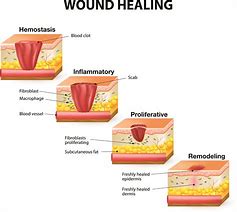 Image result for Wound Profiles
