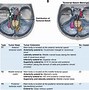 Image result for Meningioma Brain Tumors 1 Cm